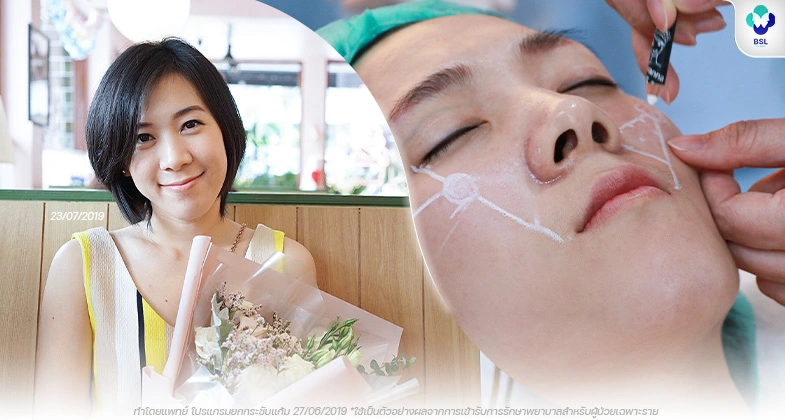 รีวิว ยกกระชับแก้ม
