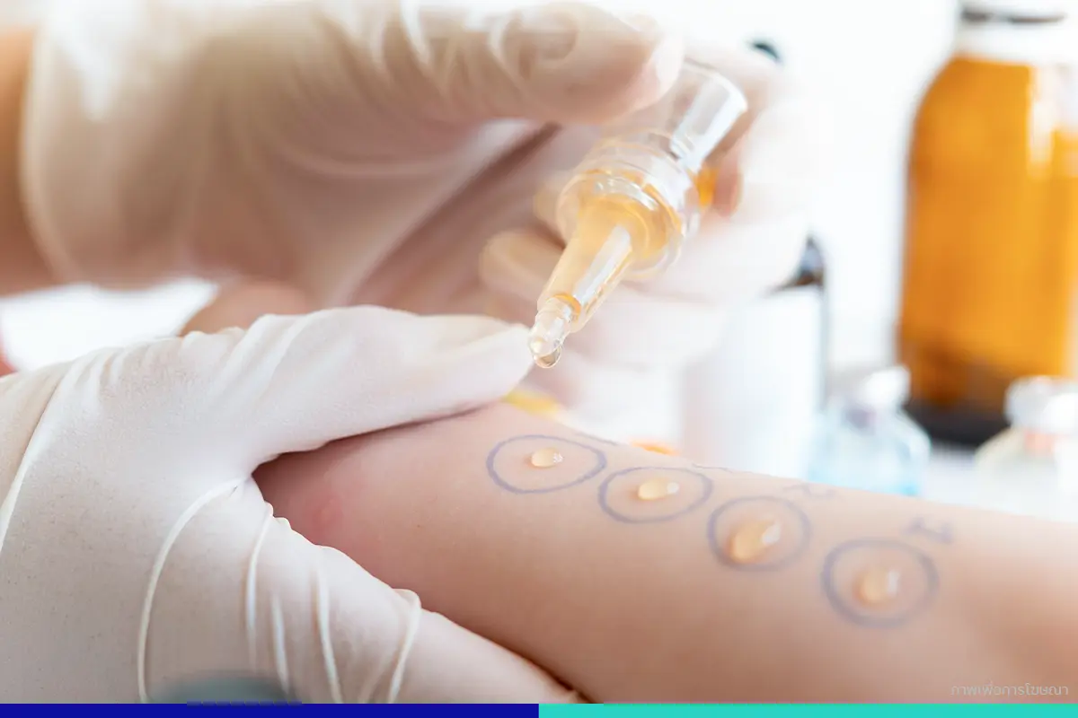 ทดสอบด้วย PATCH TEST