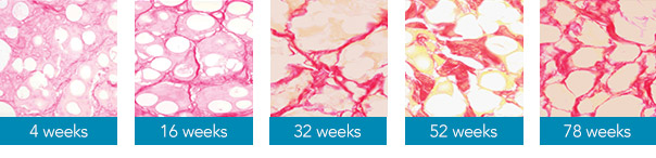 histology-radiesse-chart