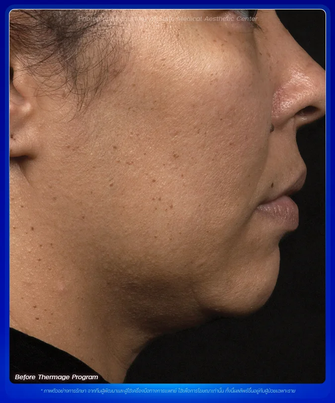 Before-After-thermage-face-bsl-clinic-03 Before-After-thermage-face-bsl-clinic