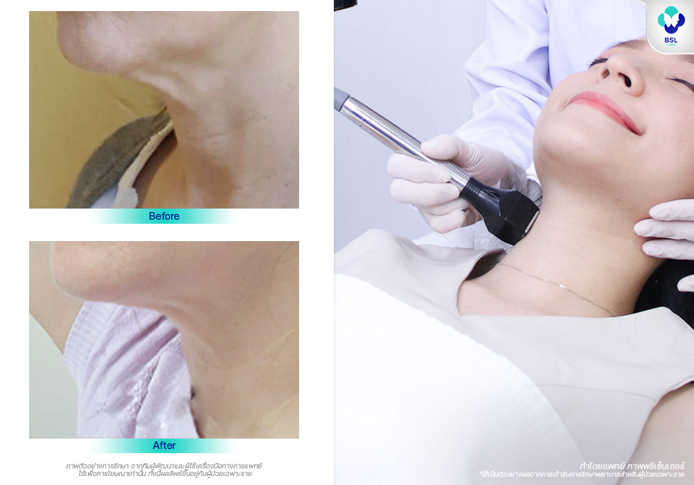 คอเหี่ยว ผิวรั้งลง - neck lifting ยกกระชับ ลำคอ