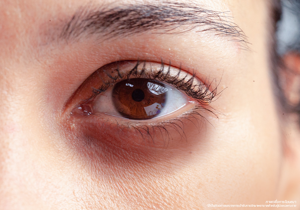 รอยคล้ำใต้ตา-ขอบตาดำ--Eyes-Wrinkle-ปัญหาผิว-รอบดวงตา