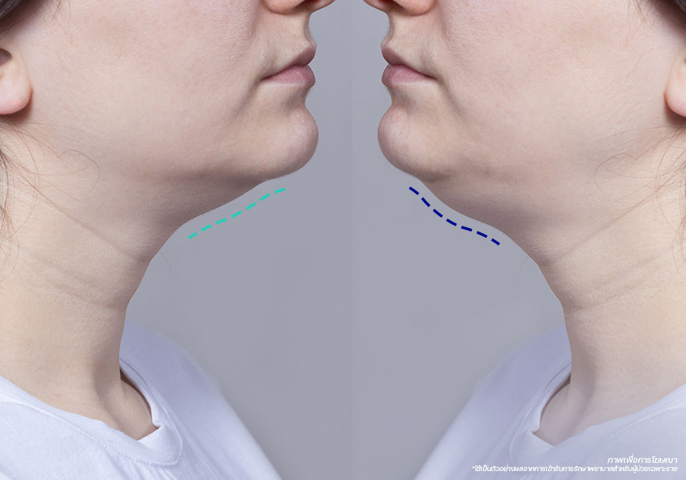 สาเหตุของปัญหา-เหนียง-ใต้คาง---neck-wattle-กำจัด-เหนียง