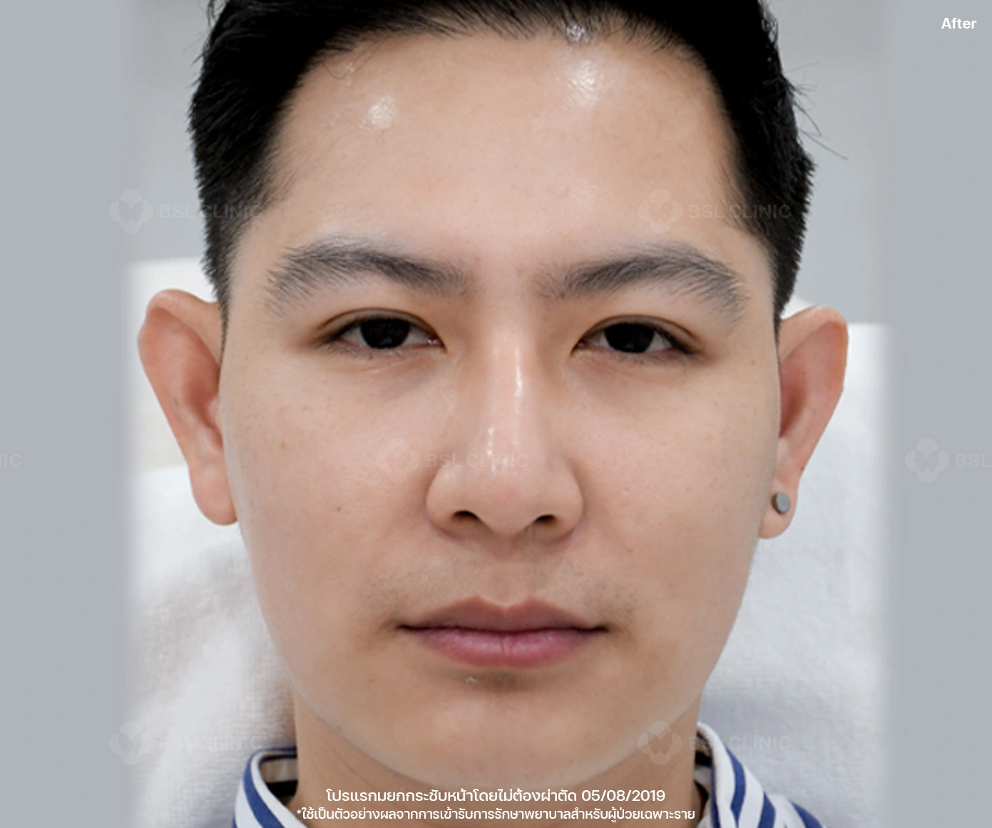 หลังรักษา 4D face lift