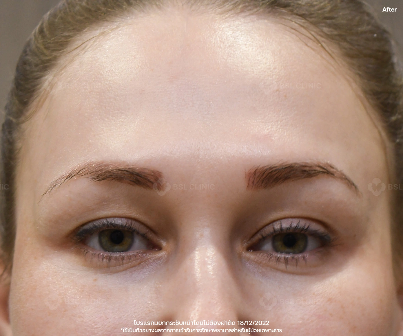 หลังรักษา 4D face lift
