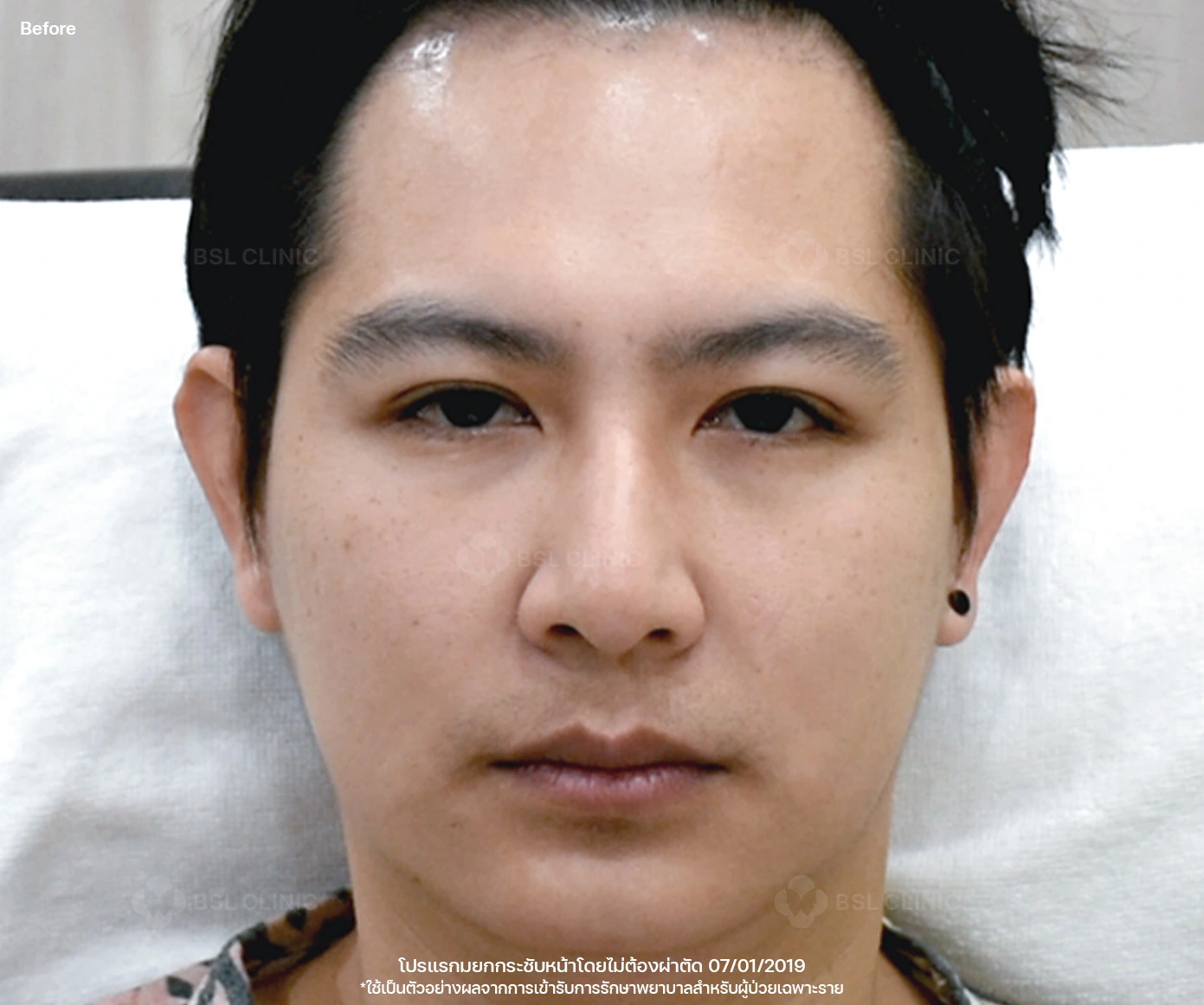 ก่อนรักษา 4D face lift