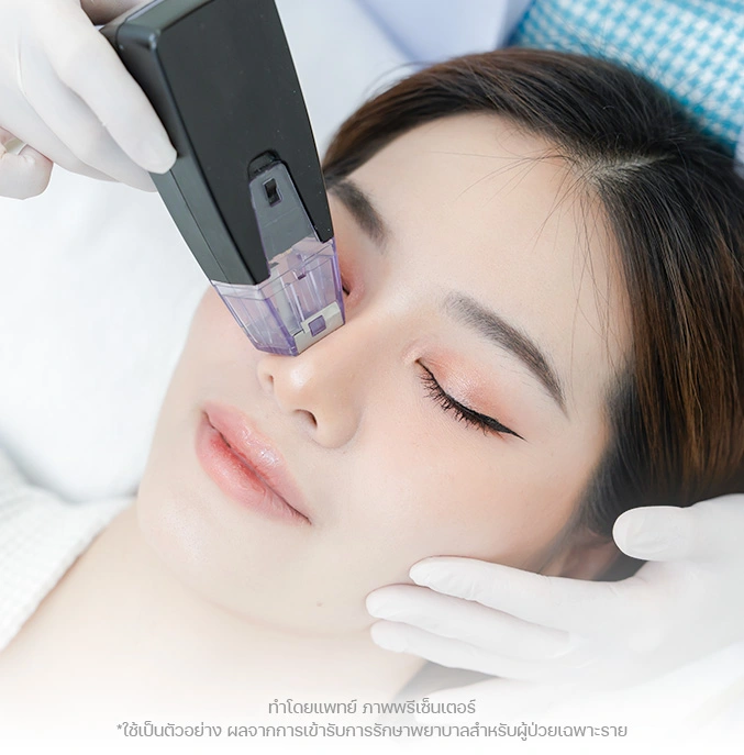 morpheus8 face lift ผิวยกกระชับขึ้น