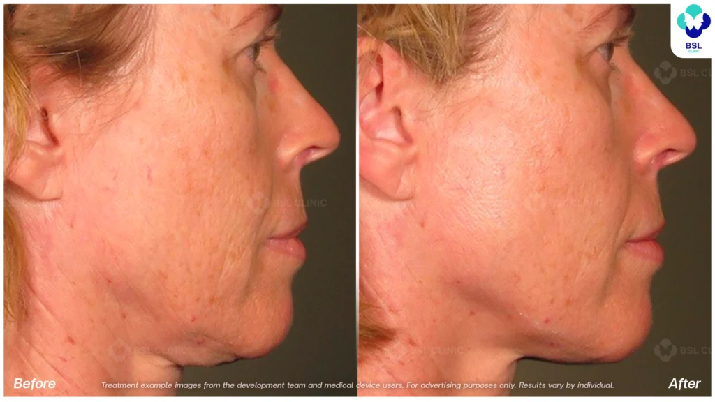 BA-result-Ulthera-face