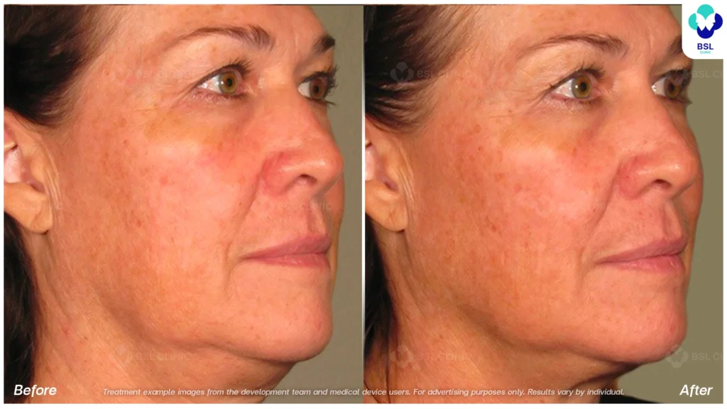 BA-result-Ulthera-face