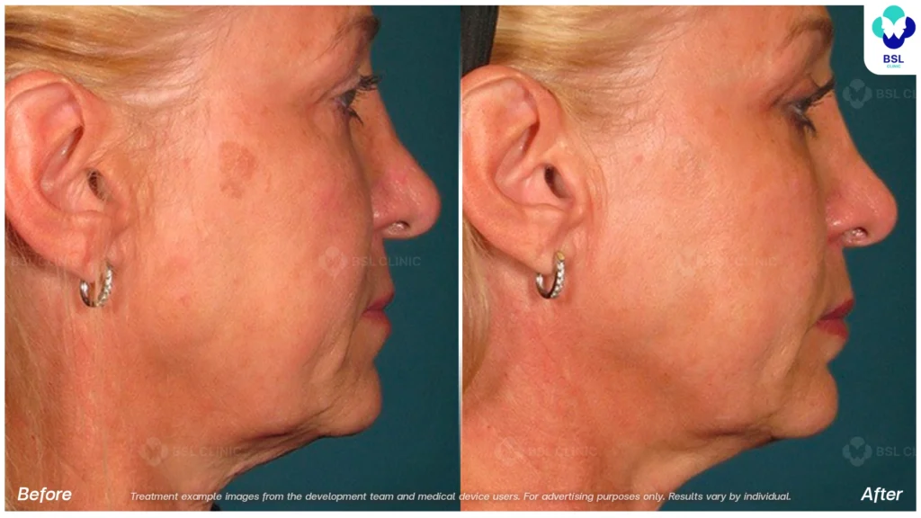 BA-result-Ulthera-face