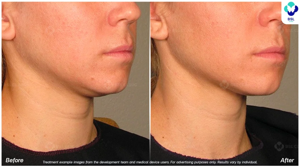 BA-result-Ulthera-face