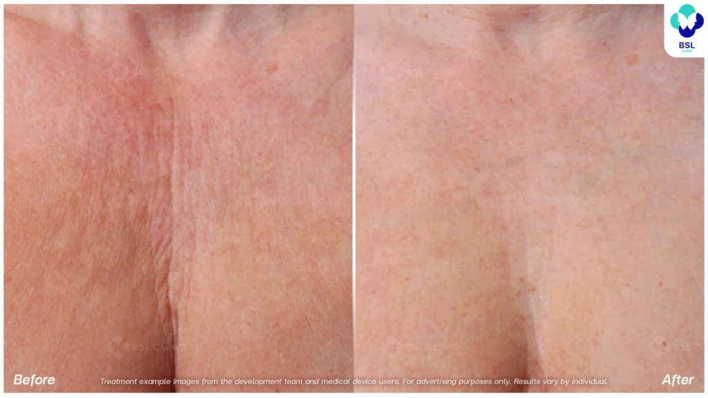 BA-result-Ulthera-Chest
