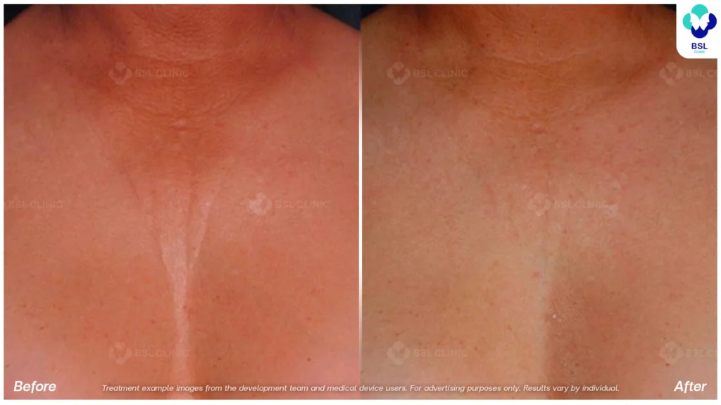BA-result-Ulthera-Chest