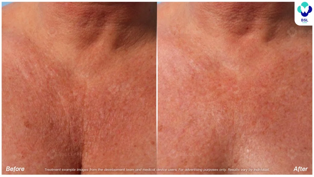 BA-result-Ulthera-Chest