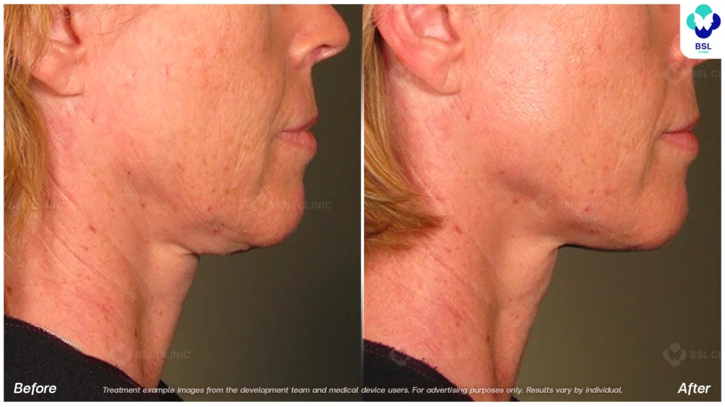 BA-result-Ulthera-Chin-and-Jawline