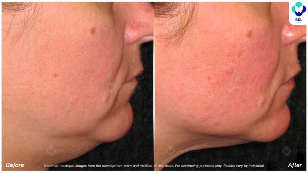 BA-result-Ulthera-Chin-and-Jawline