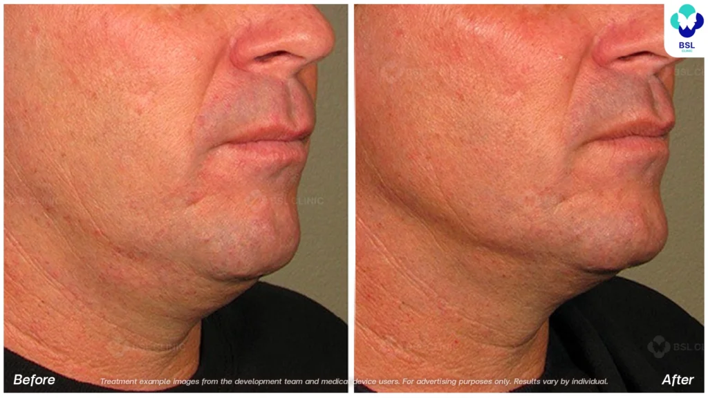 BA-result-Ulthera-Chin-and-Jawline