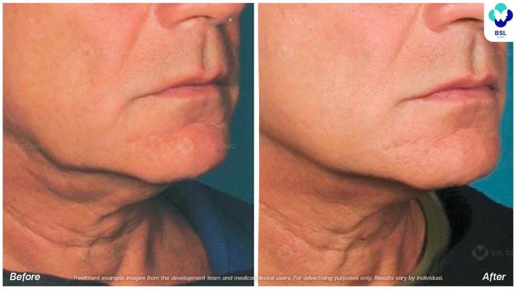 BA-result-Ulthera-Chin-and-Jawline