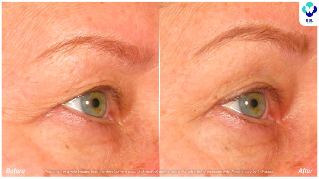 BA-result-Ulthera-Eyebrows