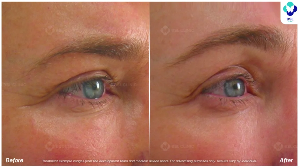 BA-result-Ulthera-Eyebrows