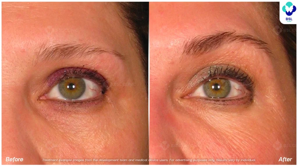 BA-result-Ulthera-Eyebrows