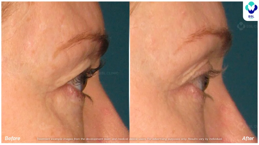 BA-result-Ulthera-Eyebrows