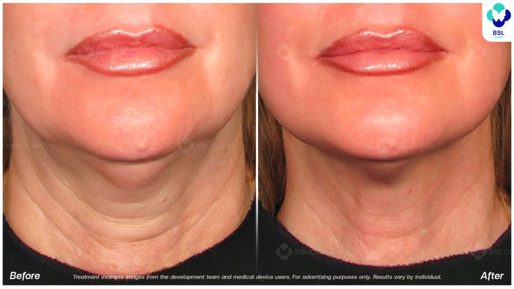 BA-result-Ulthera-Neck