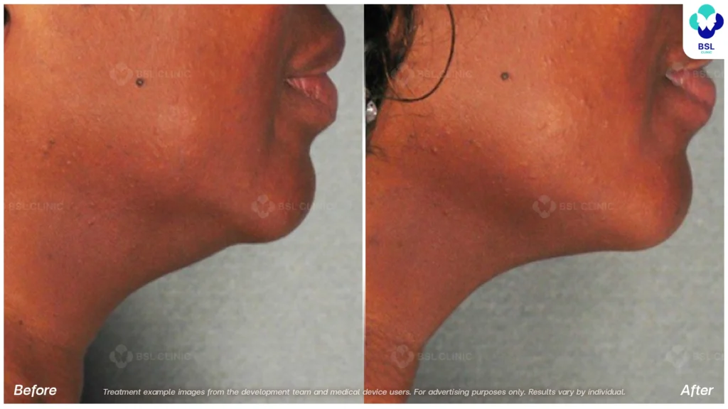 BA-result-Ulthera-Neck