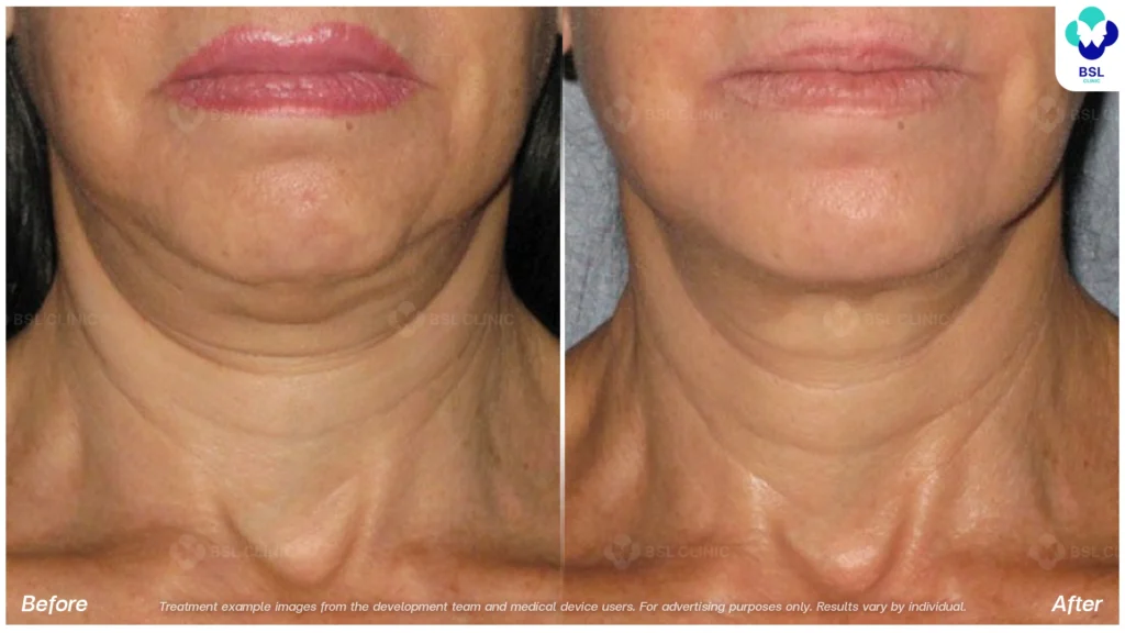 BA-result-Ulthera-Neck