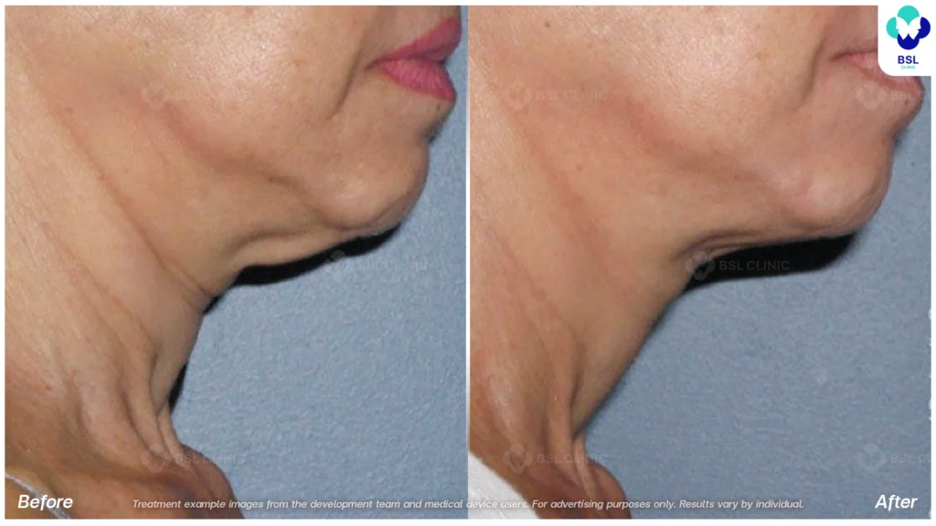 BA-result-Ulthera-Neck