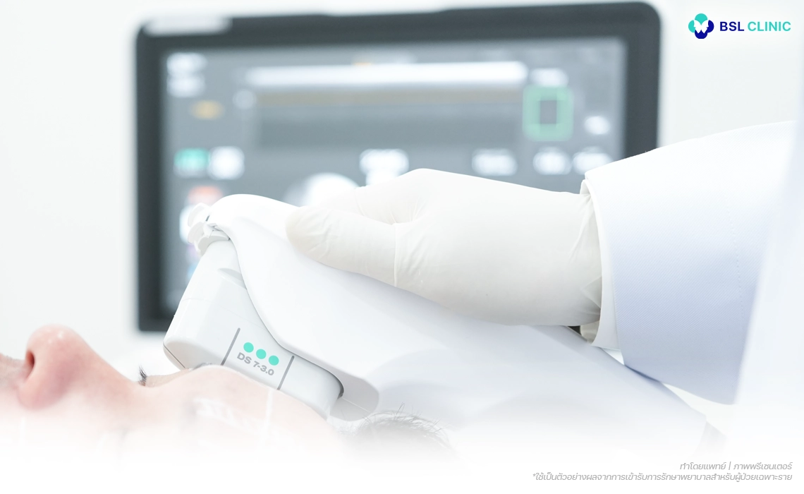 Ulthera-Prime-Program- คือ-อะไร