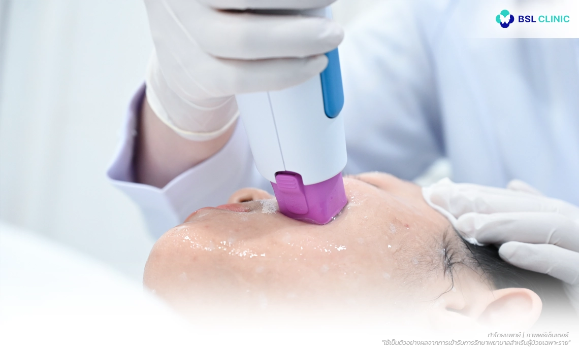 Ulthera-Prime-Program-Thermage-FLX-Program