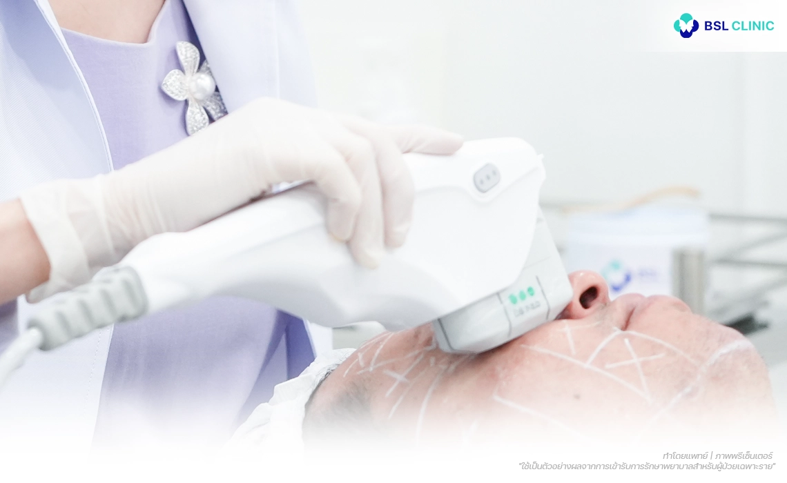 Ulthera-Prime-Program-การกระตุ้นคอลลาเจนจากชั้นลึก