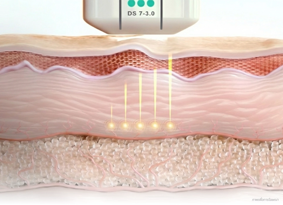 ultherapy-prime-non-invasive-face-lift-deep-dermis-collagen-3-0-mm-th