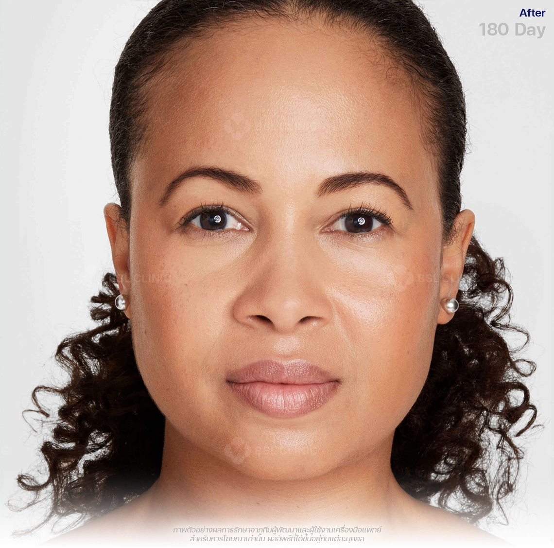 ultherapy-prime-ultherapy-before-and-after-after-180-days-ultherapy-results-th