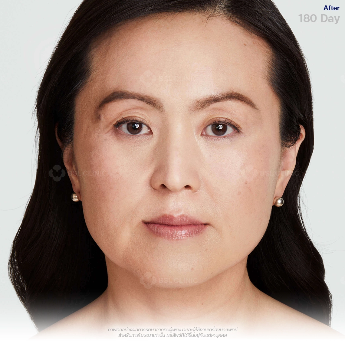 ultherapy-prime-ultherapy-before-and-after-after-180-days-ultherapy-results-th