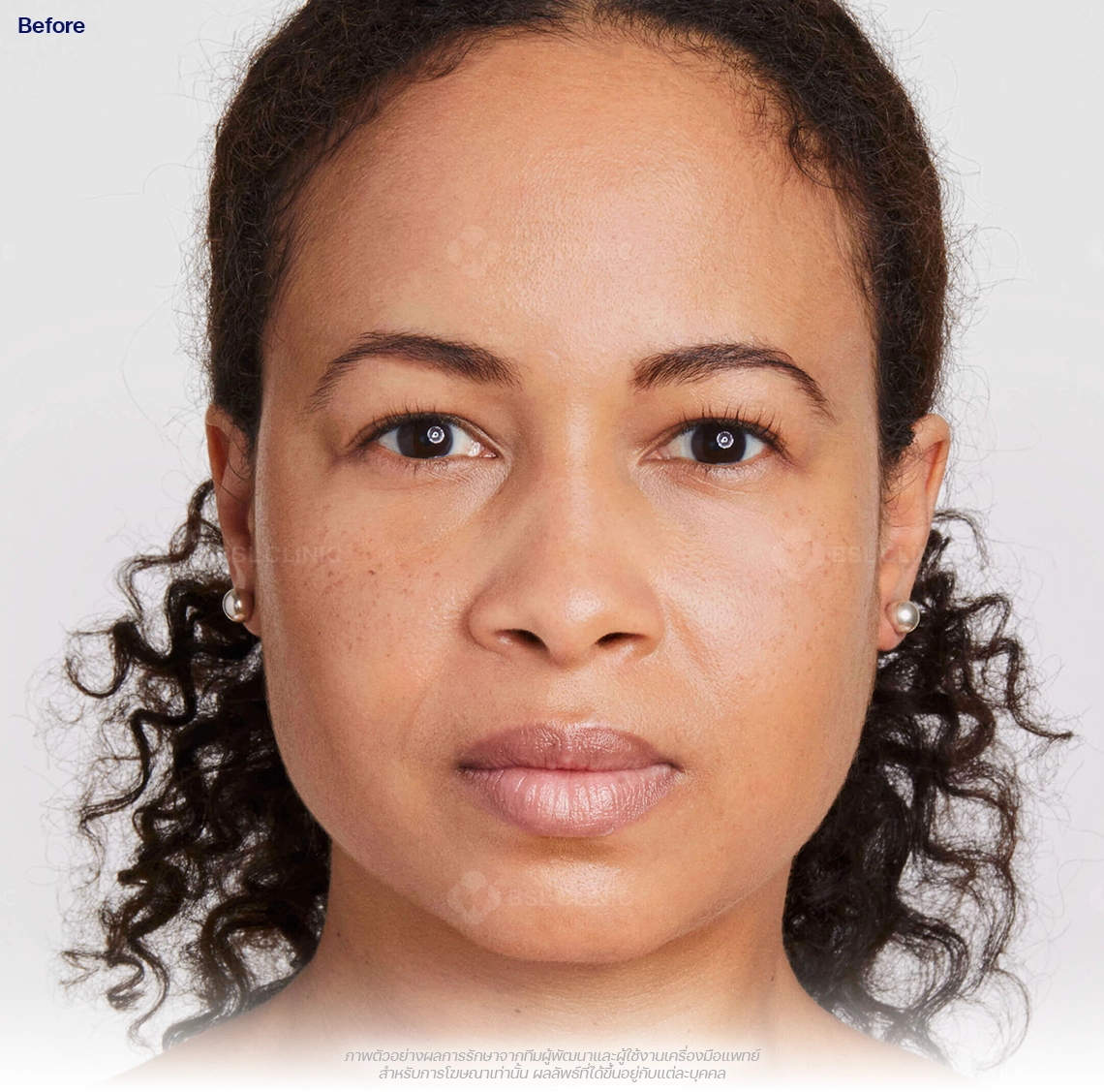 ultherapy-prime-ultherapy-before-and-after-before-180-days-ultherapy-results