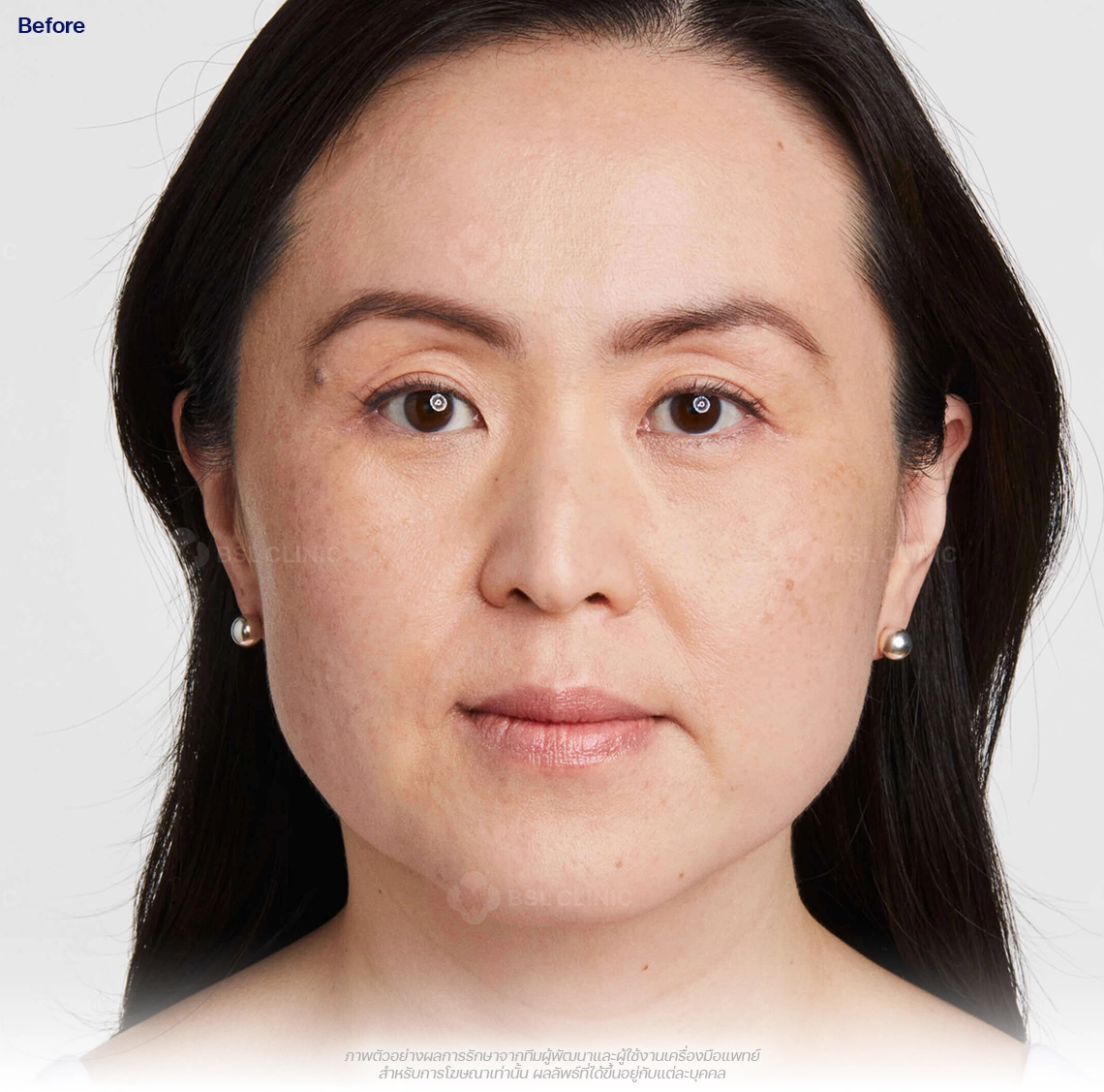 ultherapy-prime-ultherapy-before-and-after-before-180-days-ultherapy-results-th