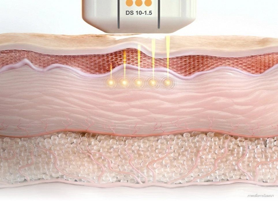 ultherapy-prime-ultherapy-non-invasive-face-lift-superficial-dermis-1-5-mm-th