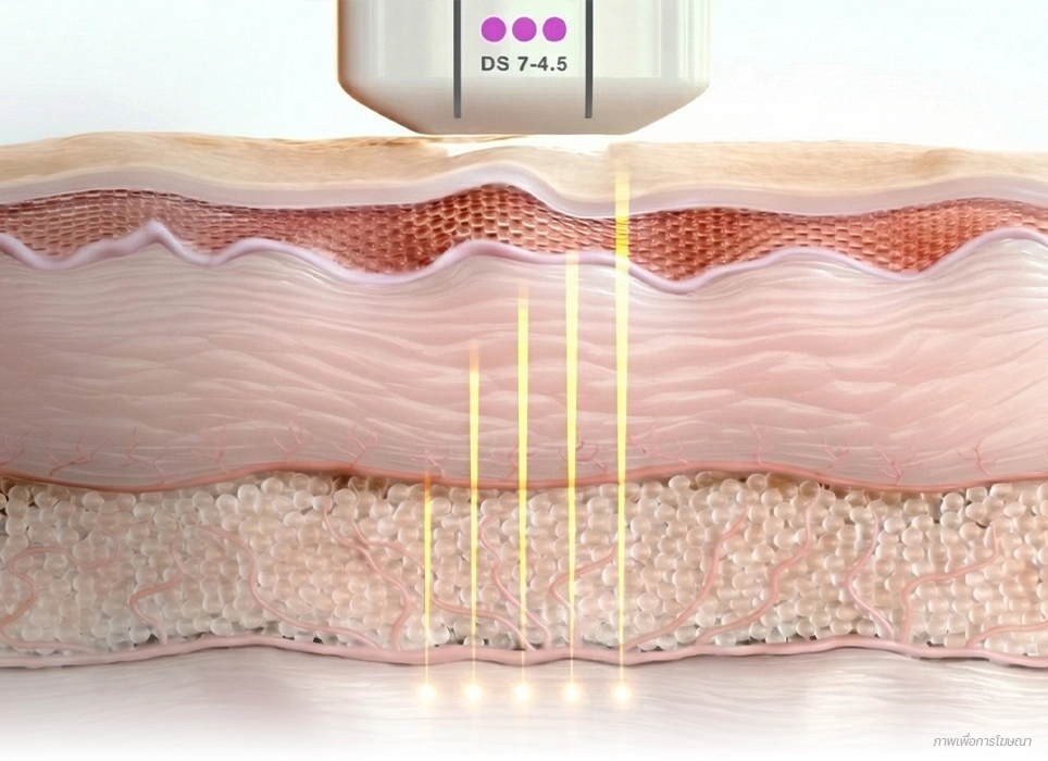 ultherapy-prime-ultherapy-non-invasive-face-lift-ultherapy-smas-4-5-mm-th