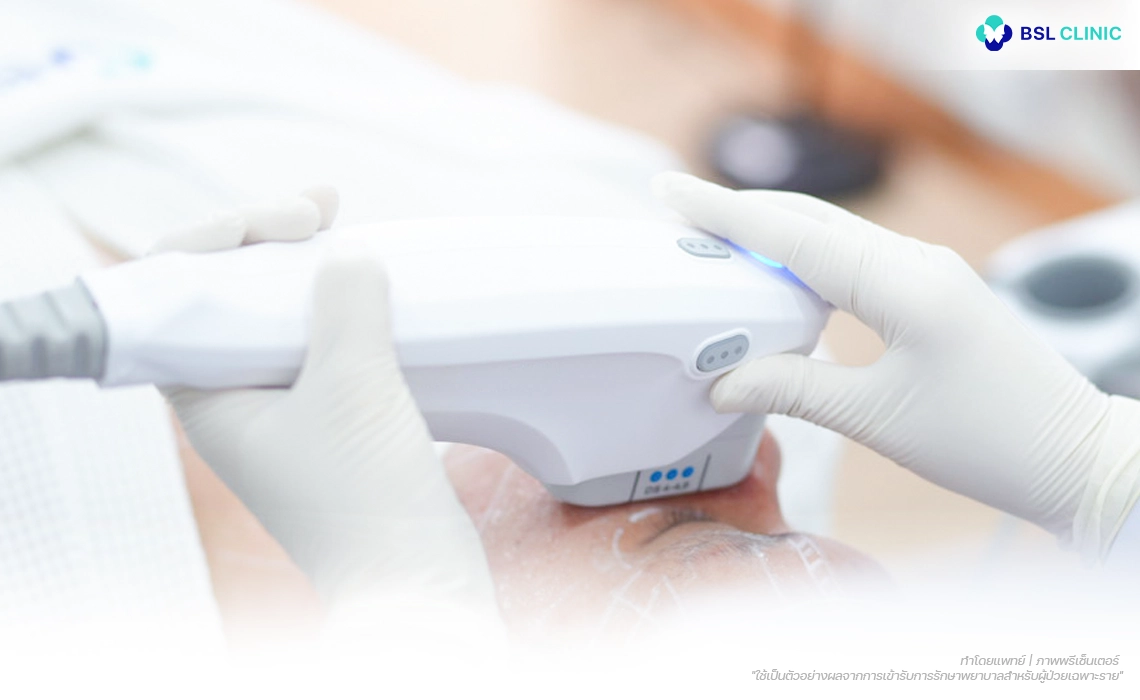Ulthera-Prime-Program-มีหลักการทำงานอย่างไร?