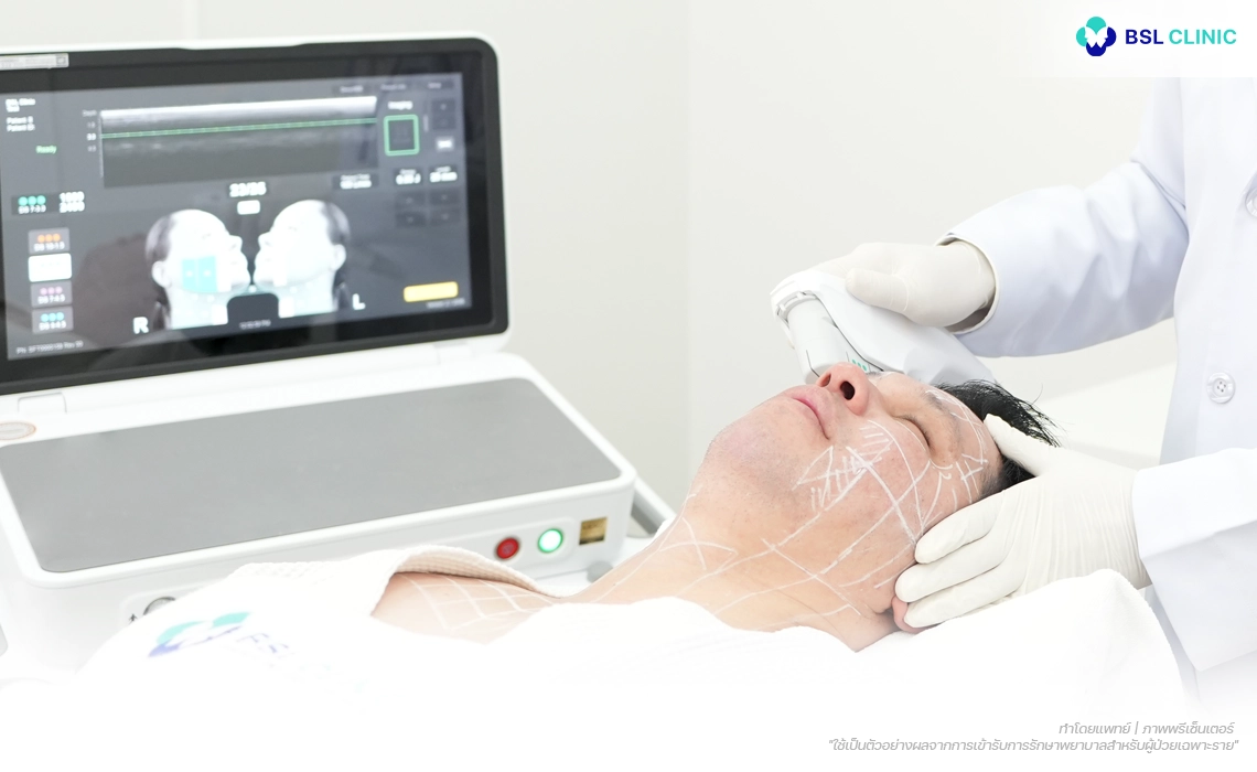 Ulthera-Prime-Program-ปรับโฉมตัวเครื่องใหม่-ให้โดดเด่นขึ้น