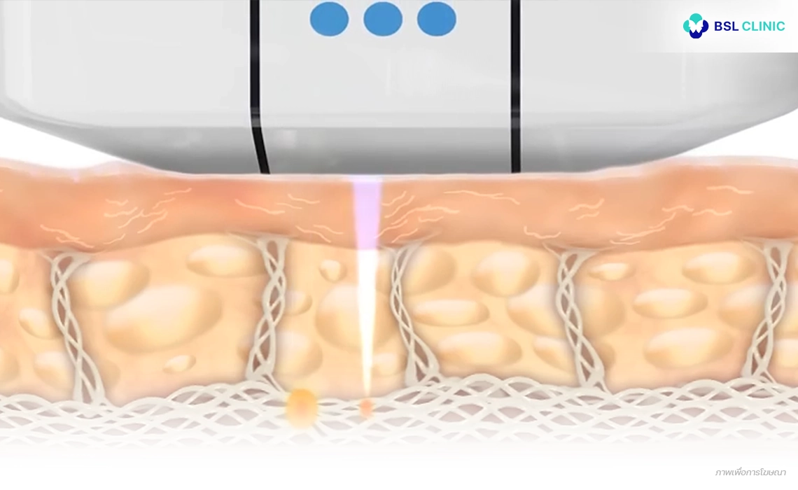 Ulthera-Prime-Program-Microfocused-Ultrasound-with-Visualization