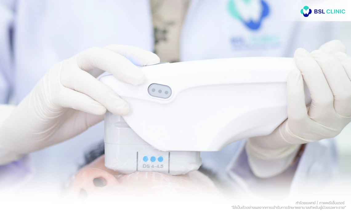 Ulthera-Prime-Program-เทคนิค-BSL-Personalized-Lift-Vectors