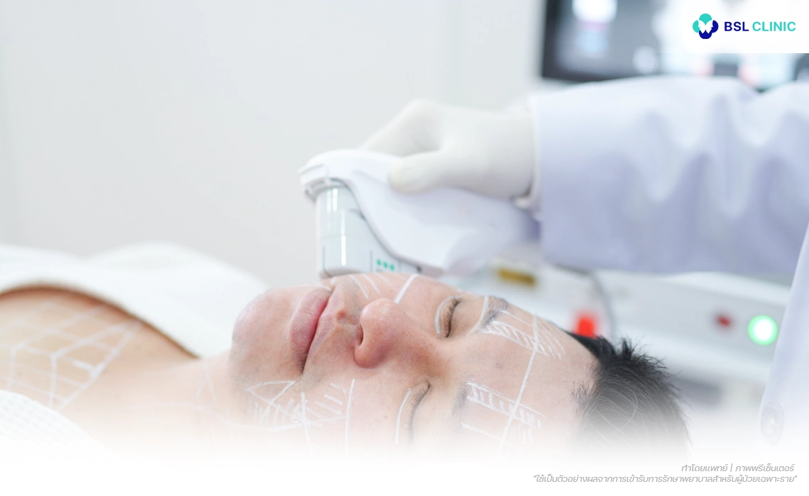 Ulthera-Prime-Program-การกระตุ้นคอลลาเจนจากชั้นลึก