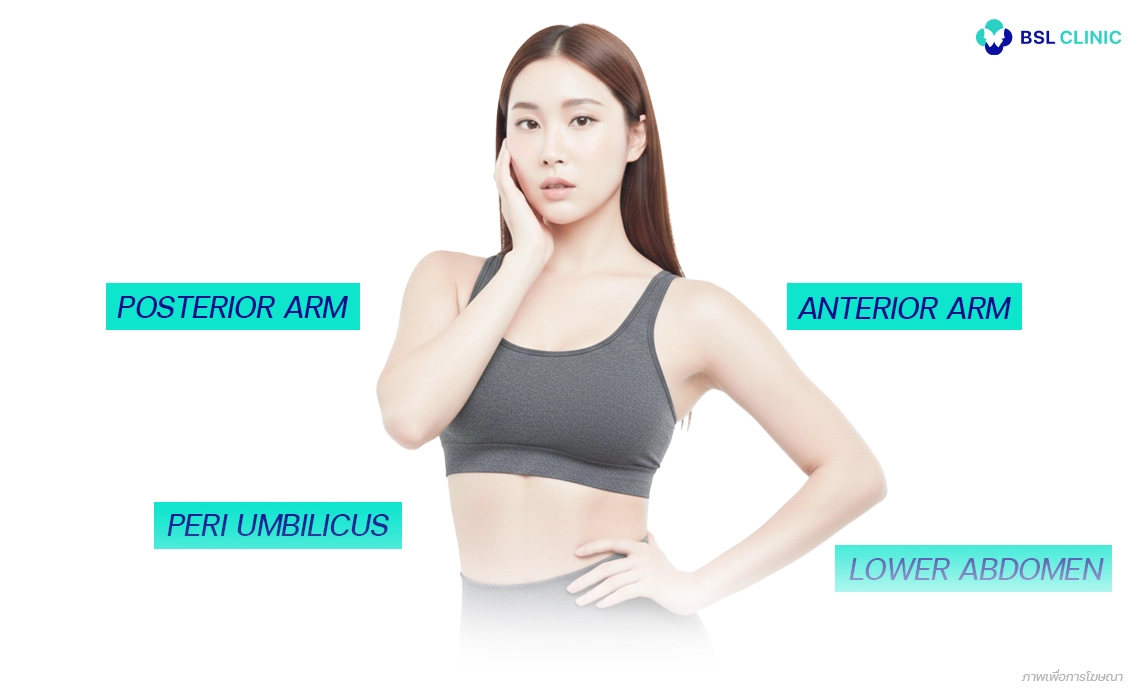 Ulthera-Prime-Program-บริเวณร่างกาย